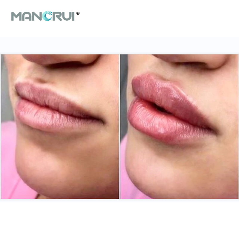 Cross Linked Hyaluronic Acid Injection Derm 2ml Lip Filler — Natural Lip Plumping, Marionette Line & Frown Line Correction, Mid-Depth Smile Line Treatment