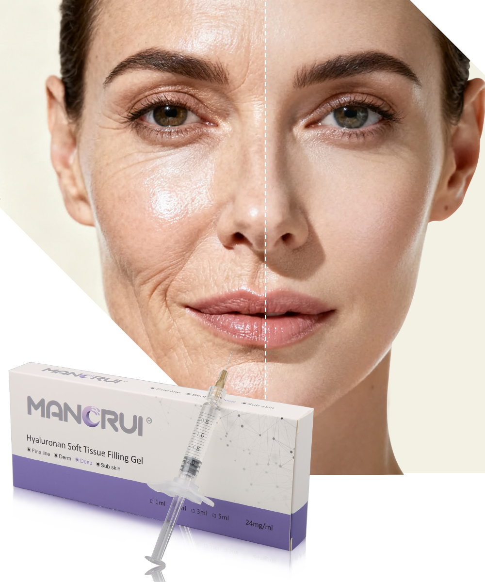 Deep 2ml Cross Linked Hyaluronic Acid Filler for Deep wrinkles and lines