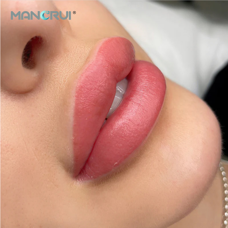 Cross Linked Hyaluronic Acid Filler Derm 2ml Lip Filler, Normal lip plumping effect., for Marionette Line, Glabella lines (frown lines) , Mid-depth smile lines