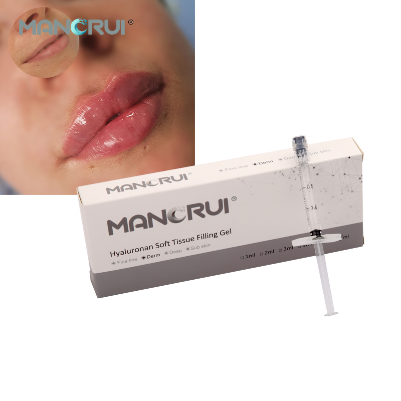 Derm 1ml Cross Linked Hyaluronic Acid Filler Lip Filler, Natural lip plumping effect.,  for Marionette Line, Glabella lines (frown lines) , Mid-depth smile lines,Moderate nasolabial folds,  Cheek contour wrinkles